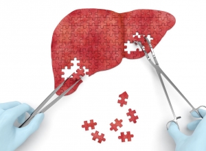 Bệnh xơ gan có mấy giai đoạn? Làm thế nào để phát hiện sớm bệnh xơ gan?
